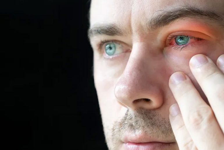 Signs of Pink Eye Symptoms of Pink Eye Redness Swelling Teary Eyes